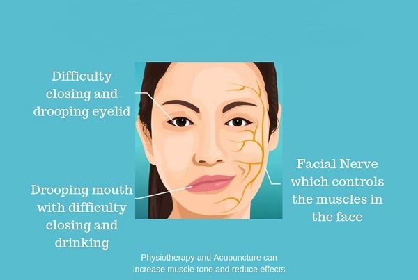Facial Palsy