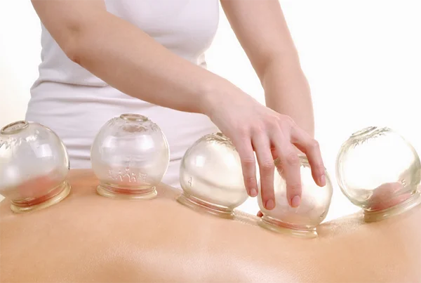 Cupping Therapy